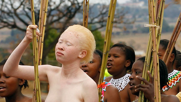 Африканские альбиносы: дар или проклятие?